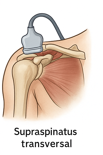 Supraespinoso transversal